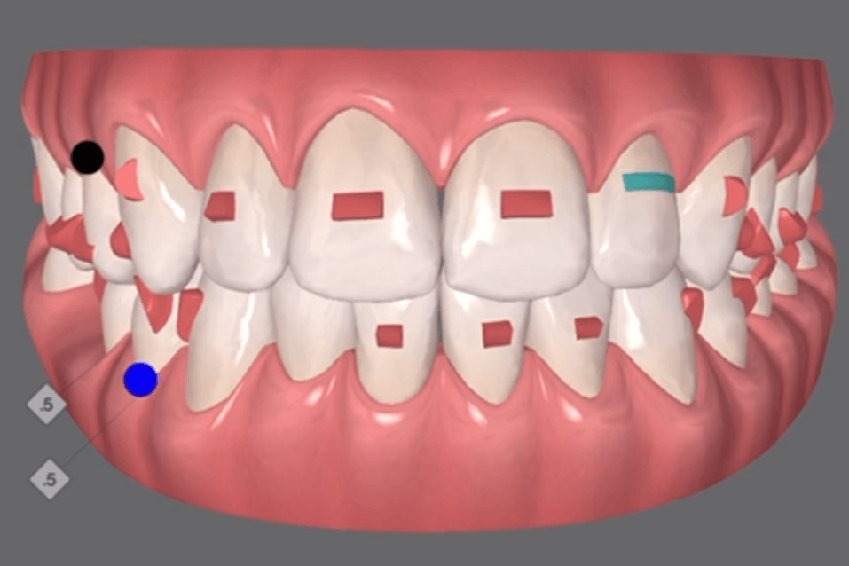 Clincheck de un paciente de RG tu Clínica Dental